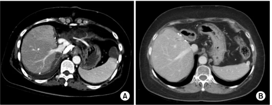 Fig. 4. Posttransplant computed  tomography (CT) findings. (A)  A CT image taken at 2 weeks  after liver transplantation showed  no abnormal finding