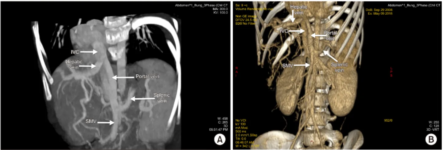 Fig. 1. (A) Abdomen 3-phase CT Scan; (B) visceral vascular 3D reconstruction showed portal vein drained into inferior vena  cava in end-to-side manner.