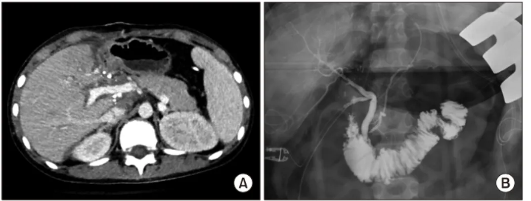 Fig. 1. Pretransplant computed tomography finding. The liver  was shrunken and liver perfusion was impaired, suggesting  a failing liver.