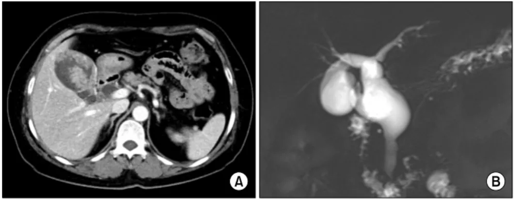 Fig. 1. Preoperative radiologic  findings. The computed  tomogra-phy scan showed highly suspected  gallbladder cancer arising from  the intracystic papillary neoplasm  with underlying choledochal cyst  (A)