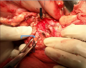 Fig. 1. Image showing technique of blunt dissection through  anterior surface of the pancreatic parenchyma with the  at-tempt to define posterior pancreatic capsule in head of the  pancreas (marked with transparent arrow)