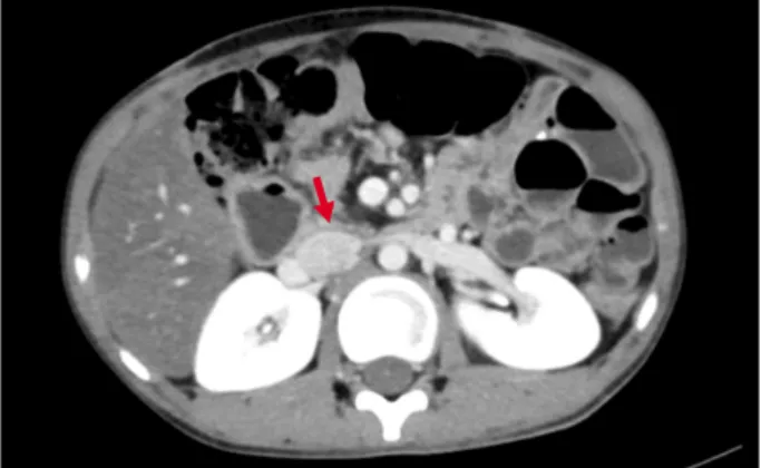 Fig. 5. CECT abdomen image of postoperative patient – six  months following bile duct preserving pancreatic head  section with posterior pancreatic capsule as the limit of  re-section (pointed with red arrow).