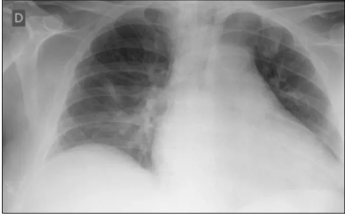 Fig. 1. Chest radiography showing diffuse bilateral infiltrates.