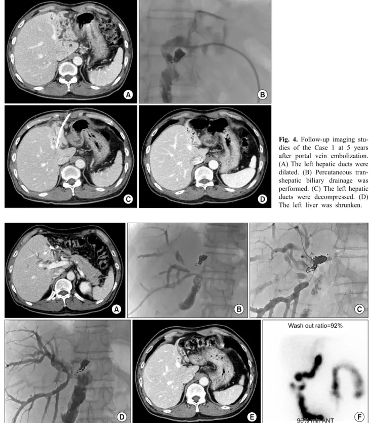 Fig. 4. Follow-up imaging stu- stu-dies of the Case 1 at 5 years  after portal vein embolization