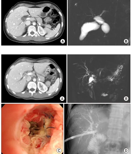 Fig. 6. Preoperative imaging  studies of the Case 2 showing  choledochal cyst of type I (A)  and no marked dilatation of the  intrahepatic ducts (B).
