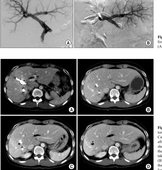Fig. 8. Right portal vein embo- embo-lization of the Case 2 before  (A) and after (B) embolization.