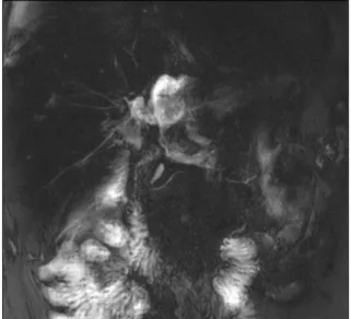 Fig. 5. Radiologic finding showing complete ischemic ne- ne-crosis of the left lateral section soon after blunt abdominal  trauma.