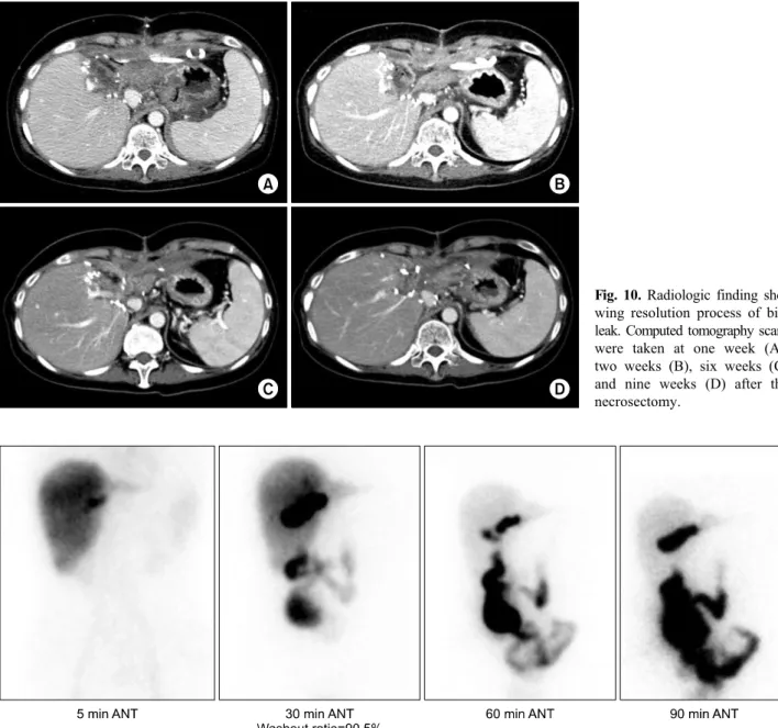Fig. 10. Radiologic finding sho- sho-wing resolution process of bile  leak. Computed tomography scans  were taken at one week (A),  two weeks (B), six weeks (C)  and nine weeks (D) after the  necrosectomy.