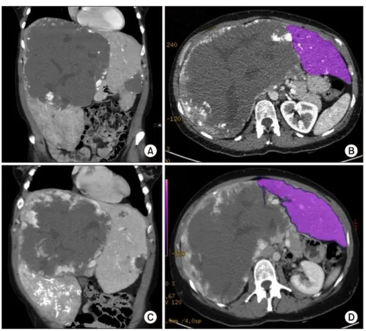 Fig. 3. CT-Scans. (A) Giant  haemangioma in the right lobe  of the liver and smaller  hae-mangioma in segment III
