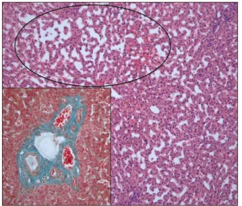 Fig. 6. (A) HE-stained sections showed the classic morphol- morphol-ogy of a cavernous haemangioma with widely dilated  vas-cular channels lined by flattened inconspicuous endothelial  cells and fibrous walls, (B) focal organized thrombi (1) and 