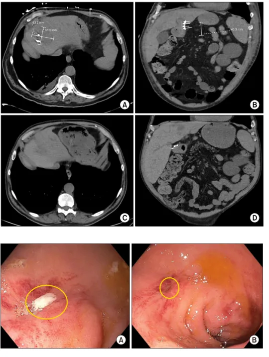 Fig. 1. CT demonstrated persis- persis-tent liver abscess with IR drain  in appropriate position (A)