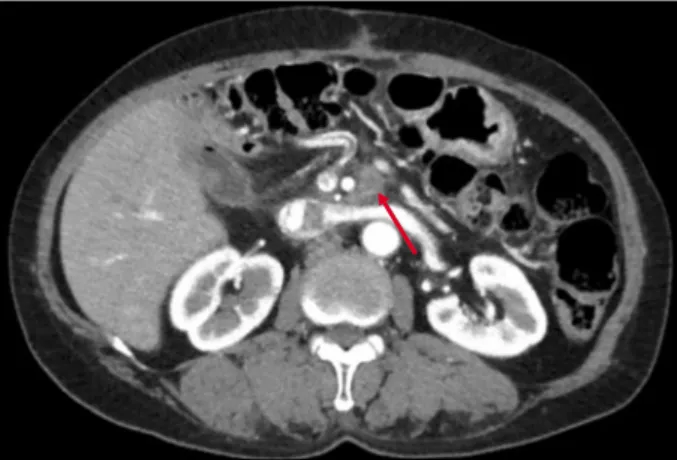Fig. 1. Nodal type local recurrence of pancreatic head cancer  on the left side of SMA.