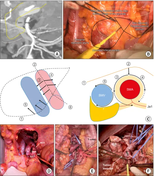 Fig. 2. Operative procedures for  PPMC. (A) Identification of  ana-tomy and variations of jejunal  arteries and veins