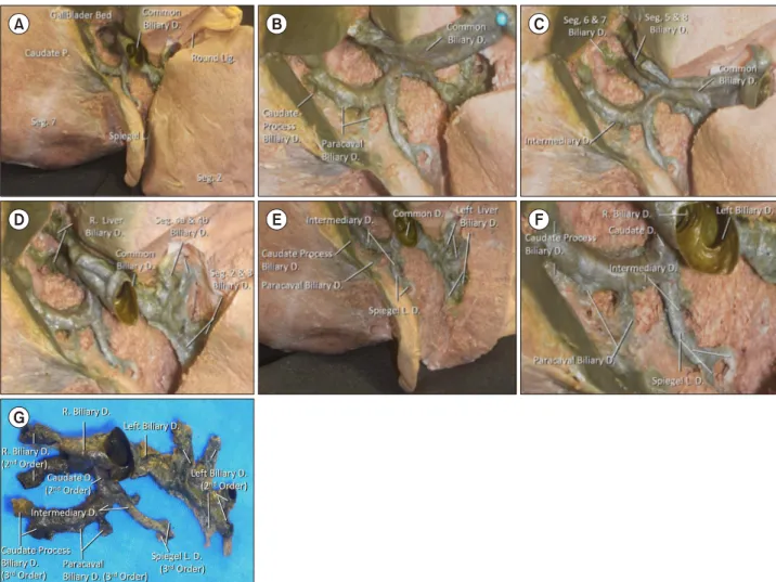 Fig. 2. Microsurgical dissection of the caudate biliary ducts after removal of vascular structures along the porta hepatis