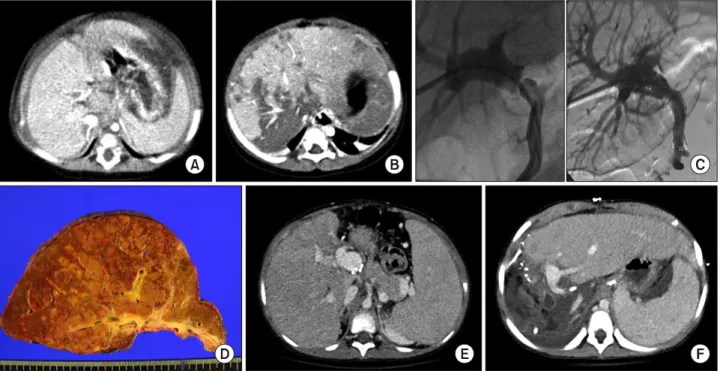 Fig. 3. Clinical sequence of Case No. 1. Computed tomography (CT) images taken preoperation (A) and at day 2 posttransplant  (B) showing the sequence of the compression-induced liver infarct