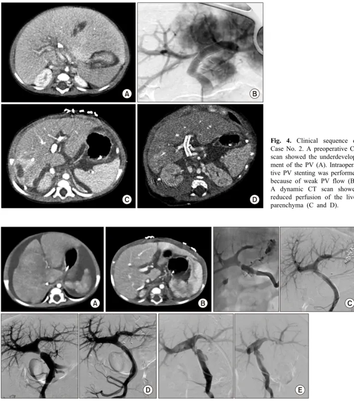 Fig. 4. Clinical sequence of  Case No. 2. A preoperative CT  scan showed the  underdevelop-ment of the PV (A)
