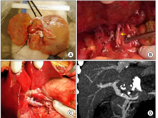 Fig. 8. Imaging findings of PV  reconstruction using the side-to-  side unification technique in  Case No