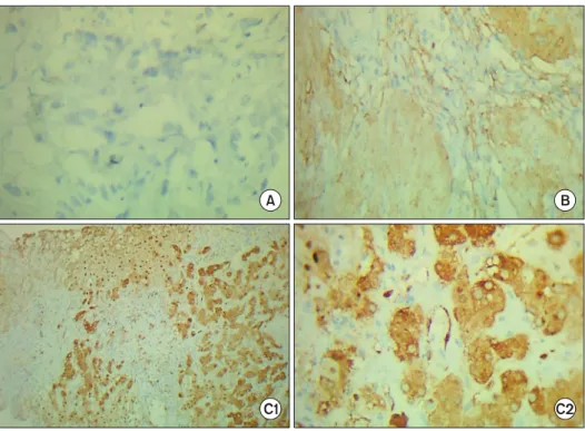 Fig. 1. Immunohistochemical  TG2 expression in gallbladder  cancer specimen (20×/40×  mag-nification)