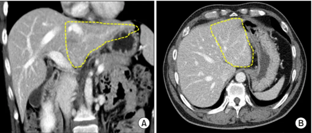 Fig. 2. Computed tomography  scans showing the graft  thick-ness-to-anteroposterior diameter  in the recipient’s abdominal  ca-vity ratio.