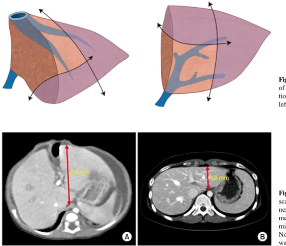 Fig. 4. Computed tomography  scans showing the graft  thick-ness (A)-to-anteroposterior  dia-meter in the recipient’s  abdo-minal cavity (B) ratio in Case  No