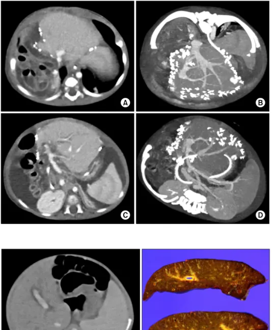 Fig. 7. Computed tomography  scan taken four days after  transplantation in the Case No