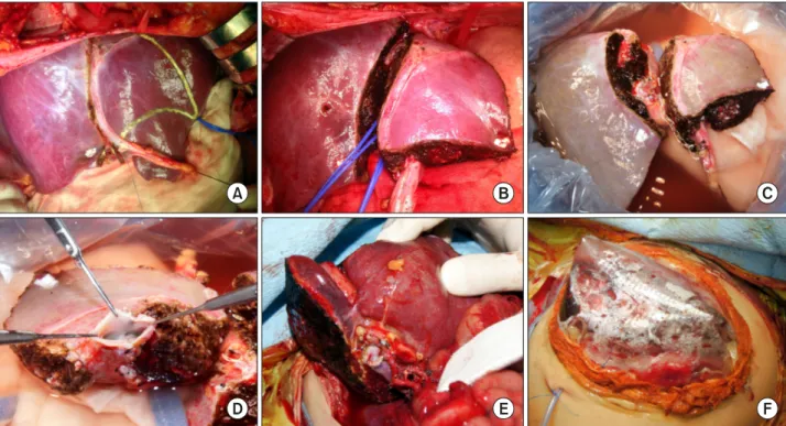 Fig. 9. Intraoperative photographs showing the surgical procedures for making a split hyperreduced left lateral segment graft  in Case No