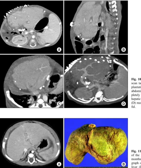 Fig. 10. Computed tomography  scan taken 14 days after  trans-plantation in Case No. 2
