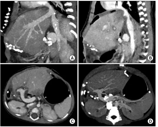 Fig. 13. Computed tomography  scan taken at 5 days after  trans-plantation in Case No