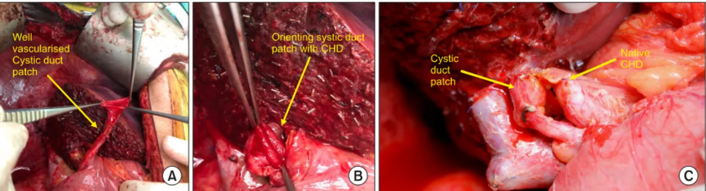 Fig. 3. Intraoperative pictures of “Cystic duct patch–CHD anastomosis.”