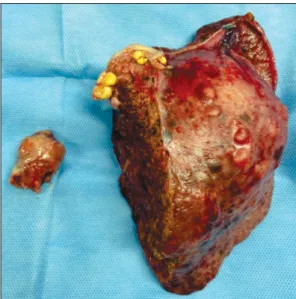 Fig. 2. Intraoperative image after left lateral parenchymal  transection and placement of cardiopulmonary bypass cannulas.
