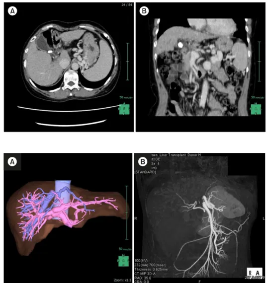 Fig. 2. (A) Preoperative simula- simula-tion of the living donor  reveal-ed her type-III PVA