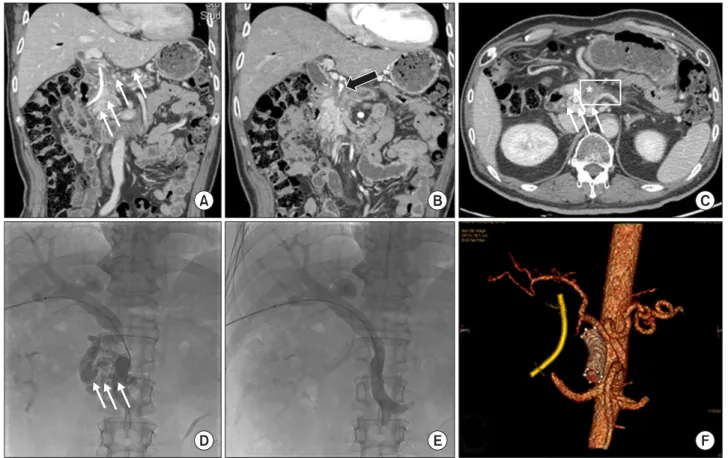 Fig. 1. Preoperative image study and PTPVS insertions. Endoscopic biliary drainage tube and periportal cavernous transformation  (thin white arrows) due to total obliteration of portal vein by the tumor (*) are noted (A and C)