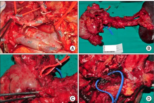 Fig. 2. Operative view and sur- sur-gical specimens. Grossly margin-  negative resection was performed