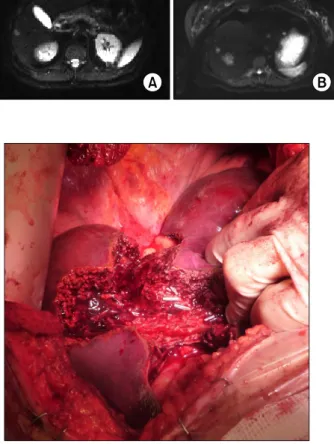 Fig. 2. Intraoperative photograph showing metastasectomies  in segment 4.