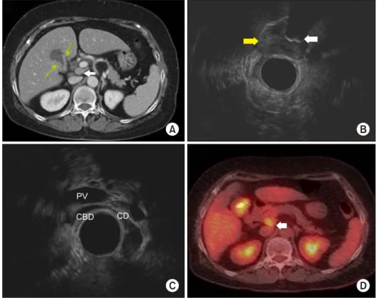 Fig. 2. Placement of trocars in laparoscopic radical cho- cho-lecystectomy.