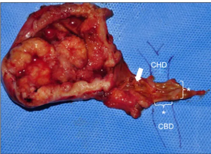 Fig. 4. Specimen image showing gross morphology of the  gallbladder tumor and extent of tumor invasion near the  cyst-ic duct (white arrow)