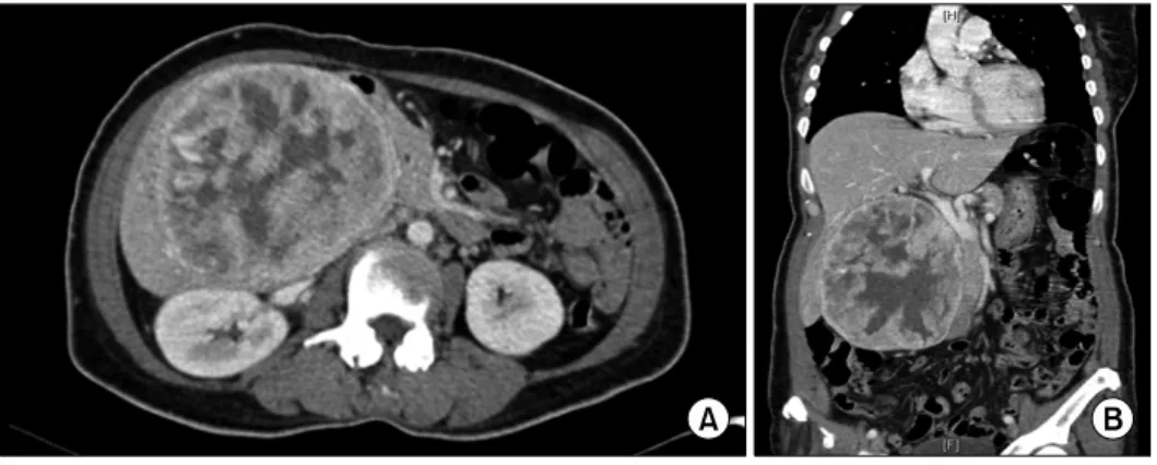 Fig. 1. Computed tomography  scan of the hepatic mass:  Axial  (A) and coronal sections (B).