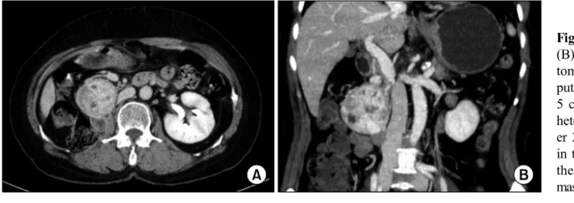 Fig. 1. Axial (A) and coronal  (B) contrast-enhanced computed tomography scan images.  Com-puted tomography scan shows a  5 cm well-defined hypervascular heterogeneous lesion and  anoth-er 2.2 cm round enhancing mass in the right retroperitoneum along the 