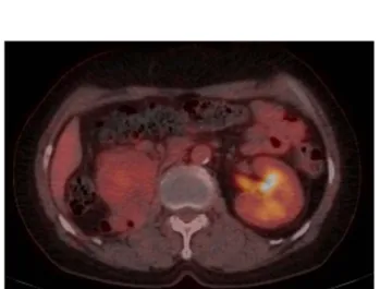 Fig. 2. T2-weighted fat-saturated magnetic resonance imaging  find-ing. Two variable-size  hyper-vascular mass lesions in the  pancreatic head and right  retro-peritoneum suggested metastatic lymph node enlargement, from  primary hypervascular mass  le-sio