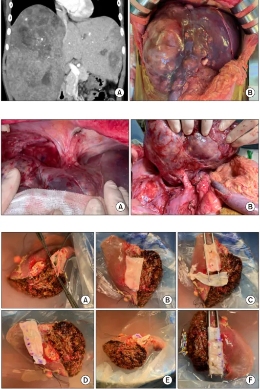 Fig. 1. Pretransplant computed  tomography finding (A) and  in-traoperative photograph (B) of  the recipient