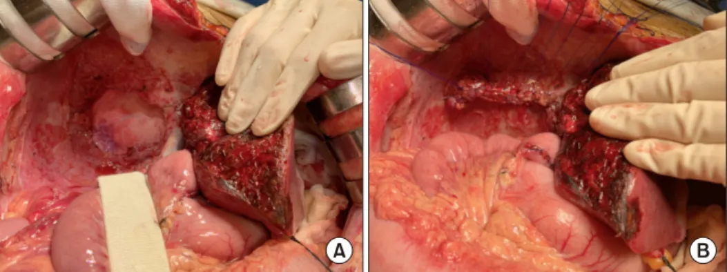 Fig. 7. Intraoperative photo- photo-graphs of the diaphragm  exci-sion. The tumor-invaded  dia-phragm was excised (A) and  re-paired directly (B).