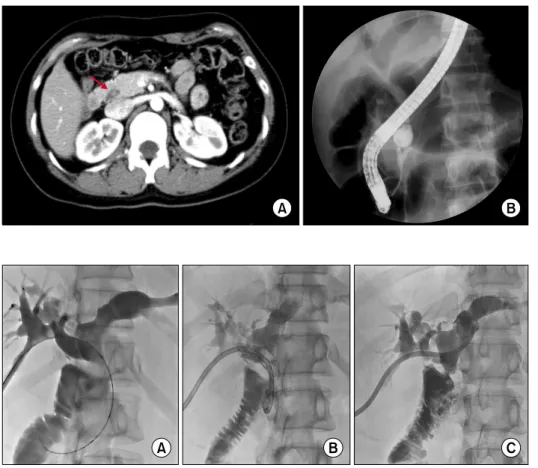 Fig. 2. Computed tomography  taken 2 years after choledochal  cyst excision. (A) A polypoid  lesion (arrow) less than 1cm  was found in the distal common  bile duct stump