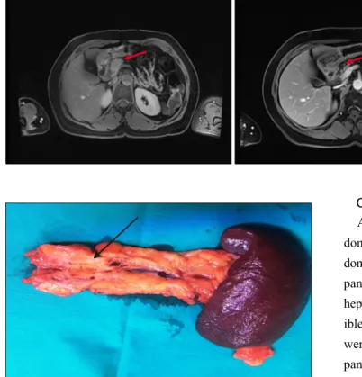 Fig. 1. Axial magnetic reson- reson-ance imaging (MRI) images  be-fore (right) and after (left) the  therapy in the neck of pancreas  (red arrow), marked tumor  shrink-age after neoadjuvant  chemora-diation is indicated with the  arrow on the second MRI-sc