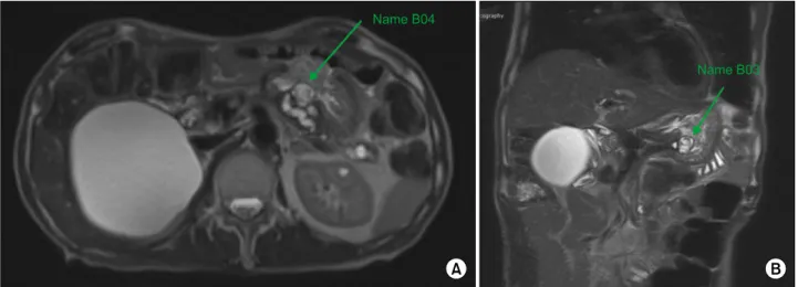 Fig. 1. Magnetic resonance of axial (A) and coronal image (B) demonstrating the worrisome-risk cystic neoplasm in the remnant  pancreas with solid component.