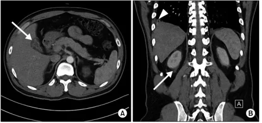 Fig. 1. Computed tomographic  findings of the patient. (A) White arrow: pericholecystic fluid and  subserosal edema with halo sign.