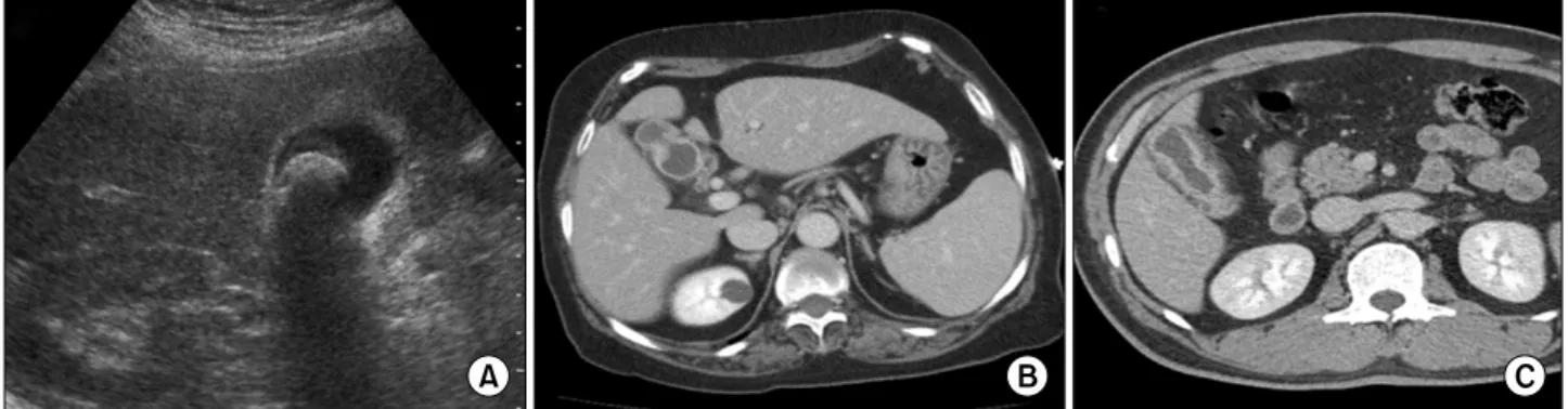 Fig. 1. Preoperative diagnostic images of gallbladder diseases. (A) Ultrasonographic finding of a patient with gallbladder cancer, considered as chronic calculous cholecystitis preoperatively