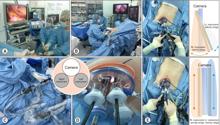 Fig. 1. Solo-SILC technical procedure. (A) Single incision laparoscopic cholecystectomy (SILC), composed of operator and cam- cam-era opcam-erator (scopist)