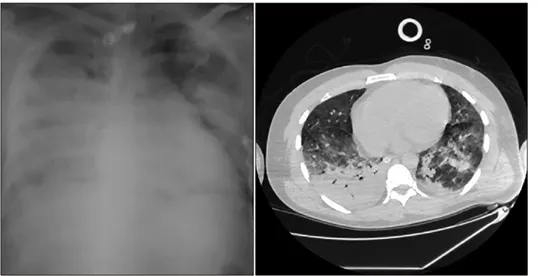 Fig. 1. The initial X-ray and  CT-scan of the chest of 48-year  old patient with SAP  compli-cated with pancreatitis-associated ARDS of moderate severity.