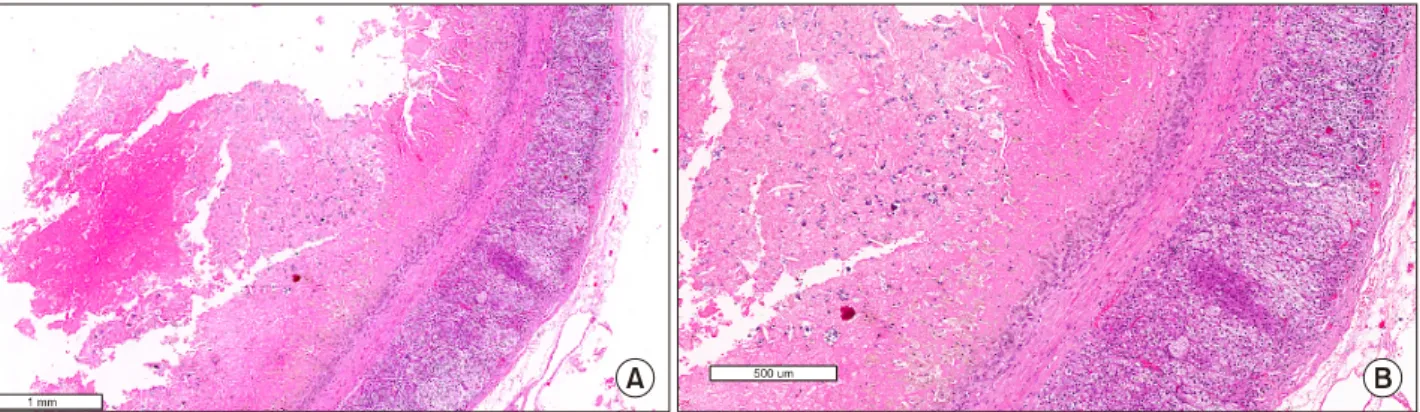 Fig. 3. Adrenal Pseudocyst situated posterior to the liver.