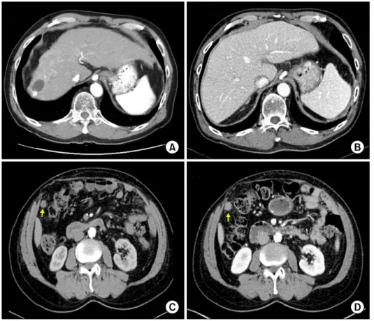 Fig. 1. Computed tomographic  images of Case 1. (A)  Pre-trans-plant finding. (B) Early post-  transplant finding